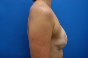 Fat Injection Before and After | Simply Breasts