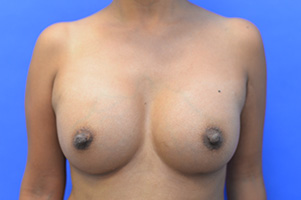 Nipple Revision Before and After | Simply Breasts
