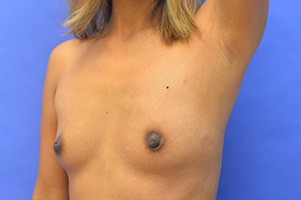 Nipple Revision Before and After | Simply Breasts